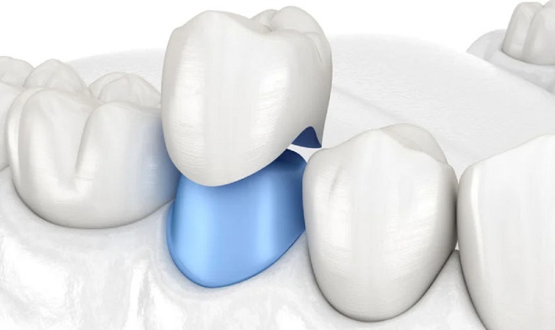 Trồng răng sứ Implant có thời gian lâu hơn