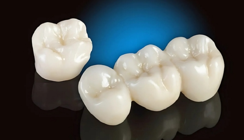 Thời gian trồng răng sứ tùy thuộc vào phương pháp thực hiện