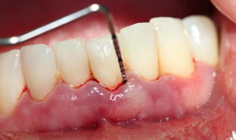 Kiểm soát viêm nha chu sẽ trồng răng được