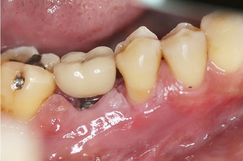 Viêm nha chu nặng có thể gây đào thải trụ trồng răng