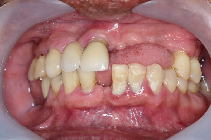 Trường hợp xương hàm mỏng bác sĩ sẽ lên phương án phù hợp