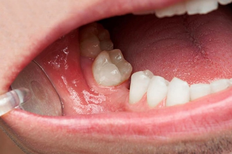 Bác sĩ xây dựng phương pháp khắc phục xương hàm mỏng phù hợp