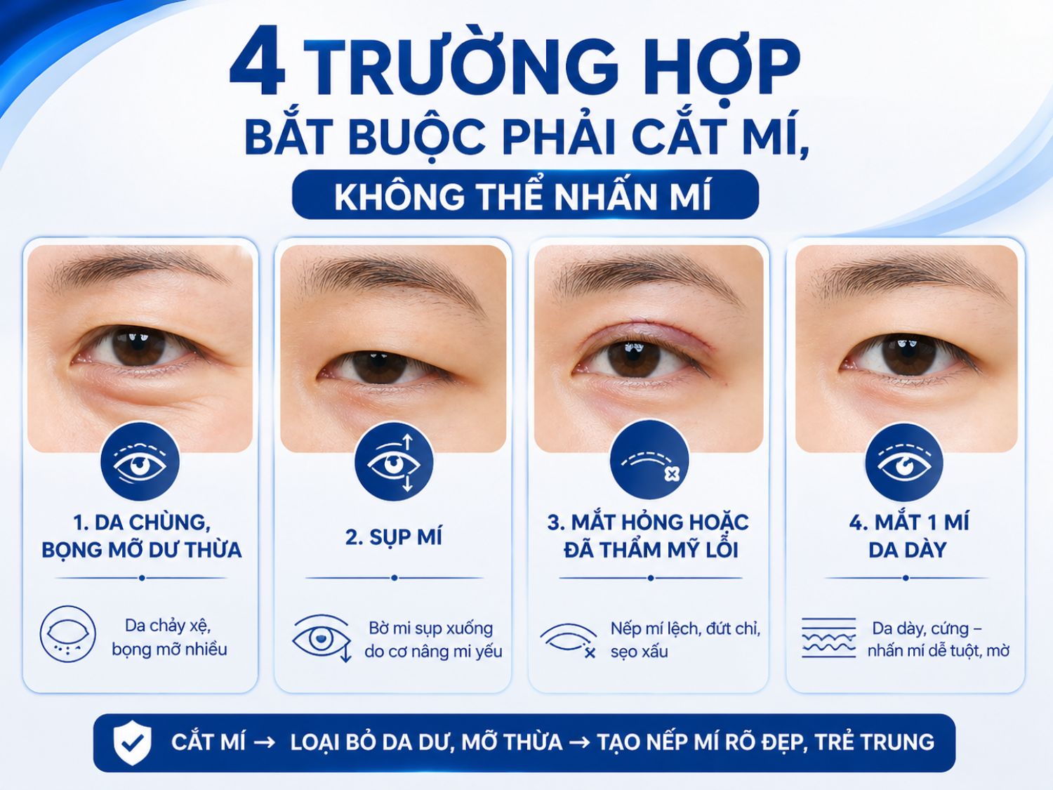 Tổng hợp các trường hợp cần cắt mí để xử lý da chùng, mỡ thừa và khuyết điểm mí mắt