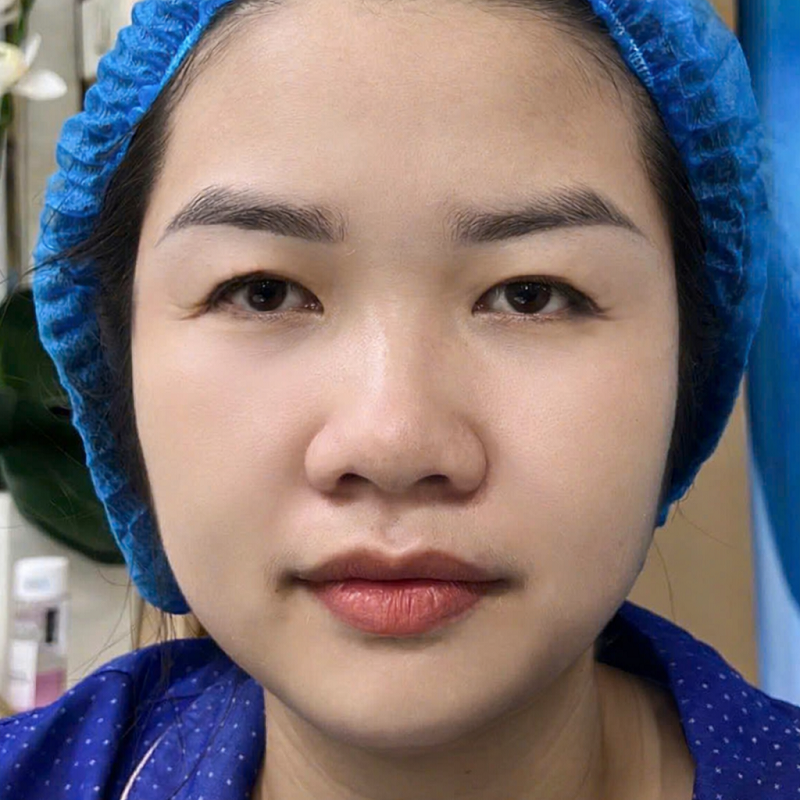 Chị Thúy Vân gặp tình trạng nếp mí sụp, nhiều da thừa 