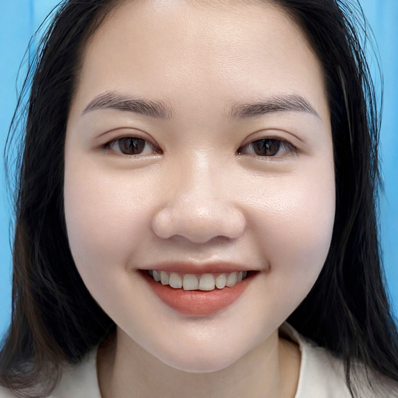 Sau khi cắt mí nếp mí cân đối, tự nhiên và hài hòa với gương mặt