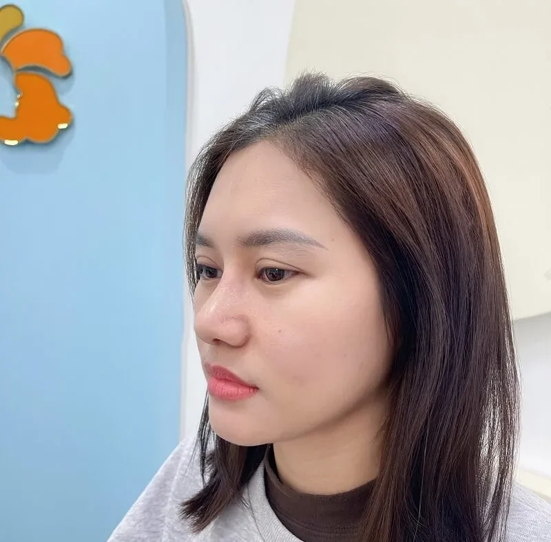 khách hàng Phương Hằng sau khi nâng mũi tại Kangnam