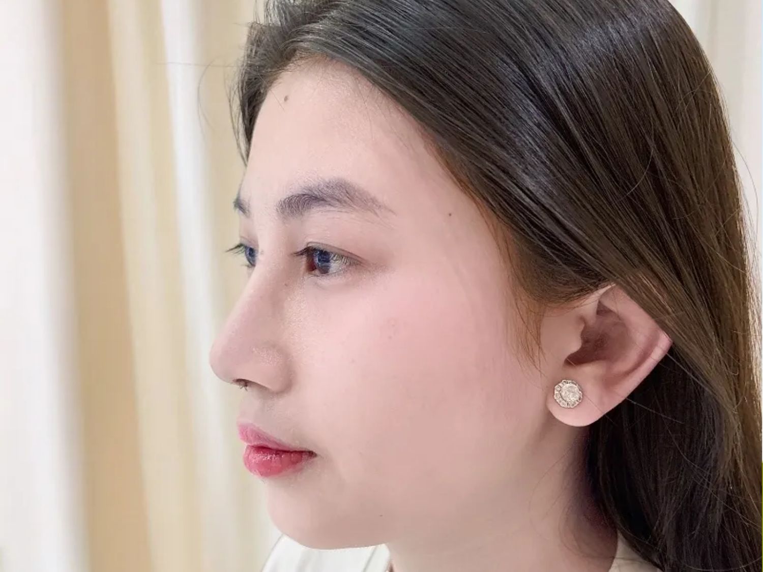 Khách hàng Thu Trang sau khi nâng mũi tại Kangnam, sở hữu dáng mũi cao tự nhiên, cân đối với các đường nét khác