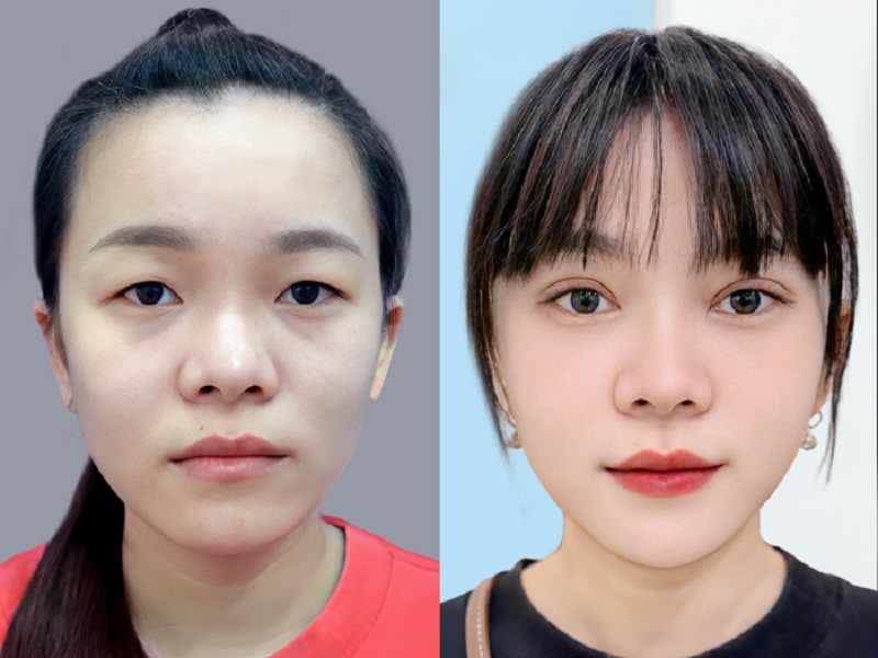 Sự thay đổi diện mạo ngoạn mục: Từ đôi mắt một mí lờ đờ sang đôi mắt hai mí chuẩn tỷ lệ vàng sau khi cắt mí tại Kangnam.