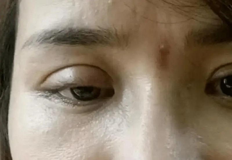 Nếp mí quá cao (>9mm) hoặc khâu siết cơ quá chặt là nguyên nhân chính khiến đôi mắt nhìn dữ dằn và lộ dấu vết thẩm mỹ.