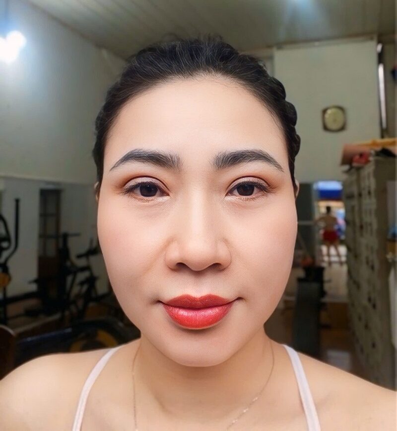 Diện mạo trẻ trung của chị Quỳnh Mai sau 7 ngày cắt mí Plasma tại Kangnam.