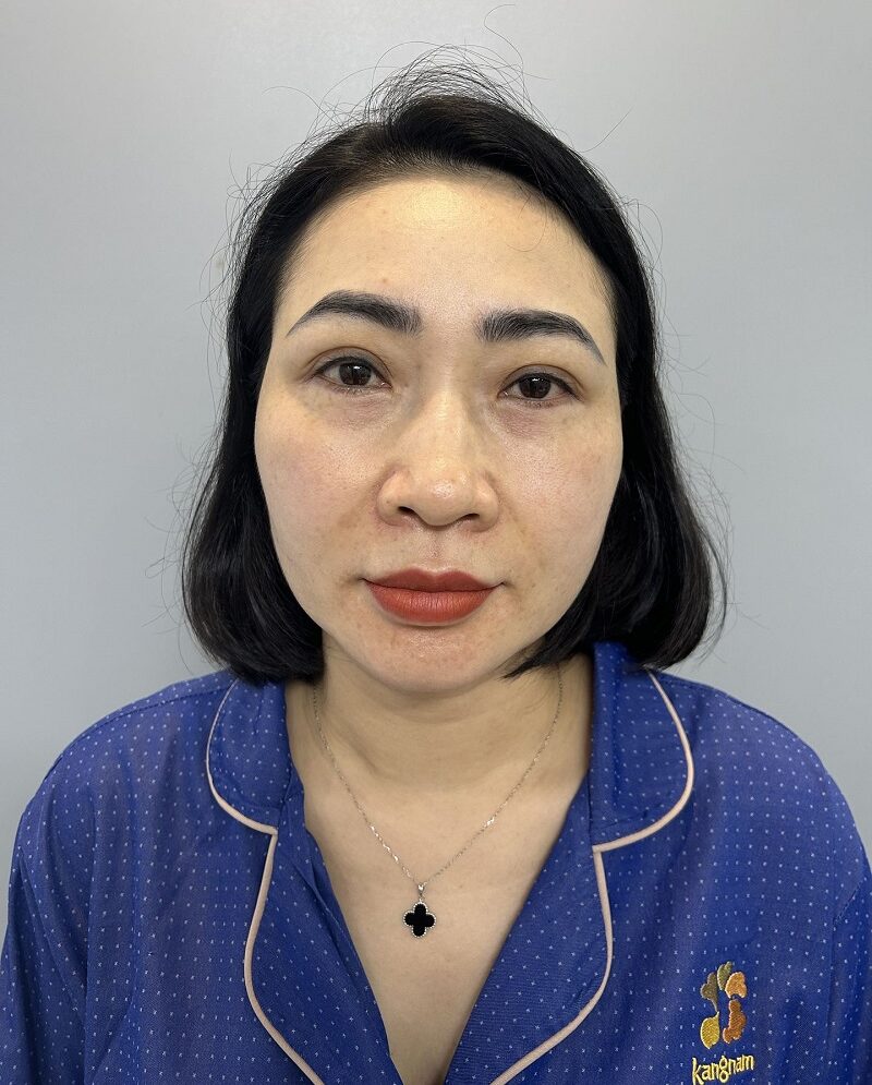 Trước khi cắt mí chị Mai gặp tình trạng nhiều da chùng, nếp mí không rõ