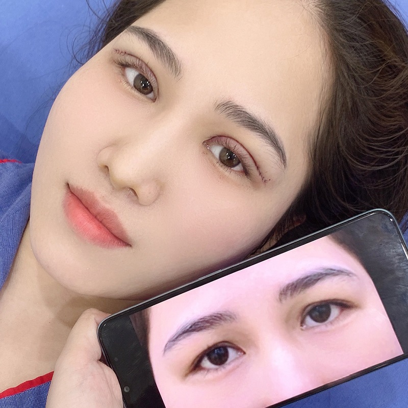 Tỷ lệ nếp mí từ 6–7mm được coi là khoảng cách "vàng" giúp đôi mắt người Việt to tròn nhưng vẫn giữ được nét tự nhiên, hài hòa.