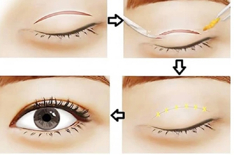 Hình ảnh mô phỏng sự khác biệt về kỹ thuật và khả năng can thiệp sâu của phương pháp cắt mí so với nhấn mí thông thường.