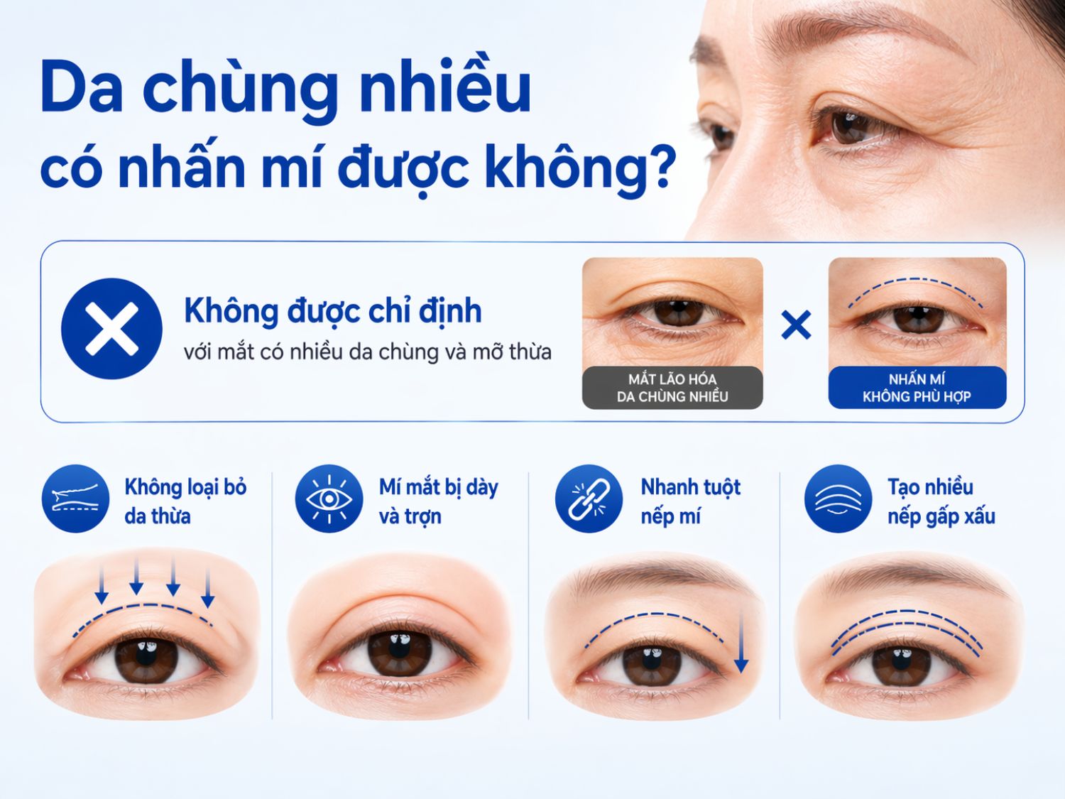 Da chùng nhiều không nên nhấn mí cảnh báo bấm mí không phù hợp với mắt có da dư và mỡ thừa