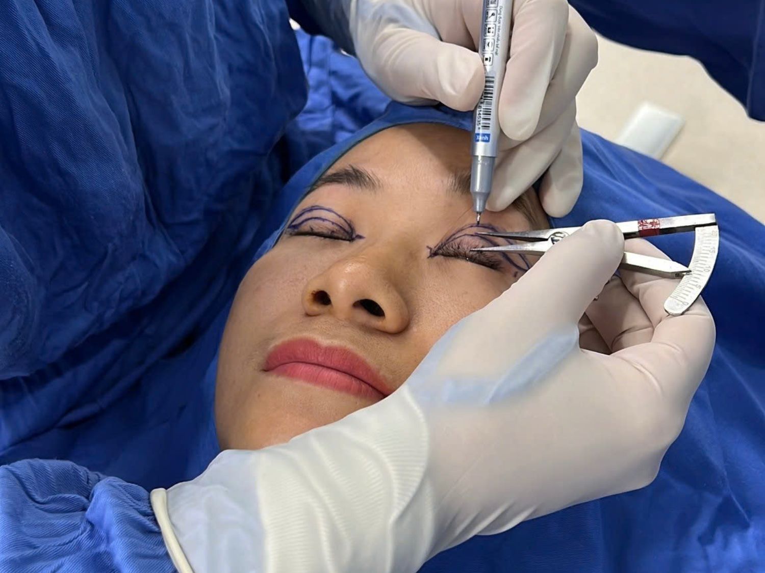 Bác sĩ sử dụng thước đo caliper chuyên dụng để xác định nếp mí mới với độ cao tối ưu (thường 6-8mm), đảm bảo sự cân đối tuyệt đối theo tỷ lệ nhân trắc học