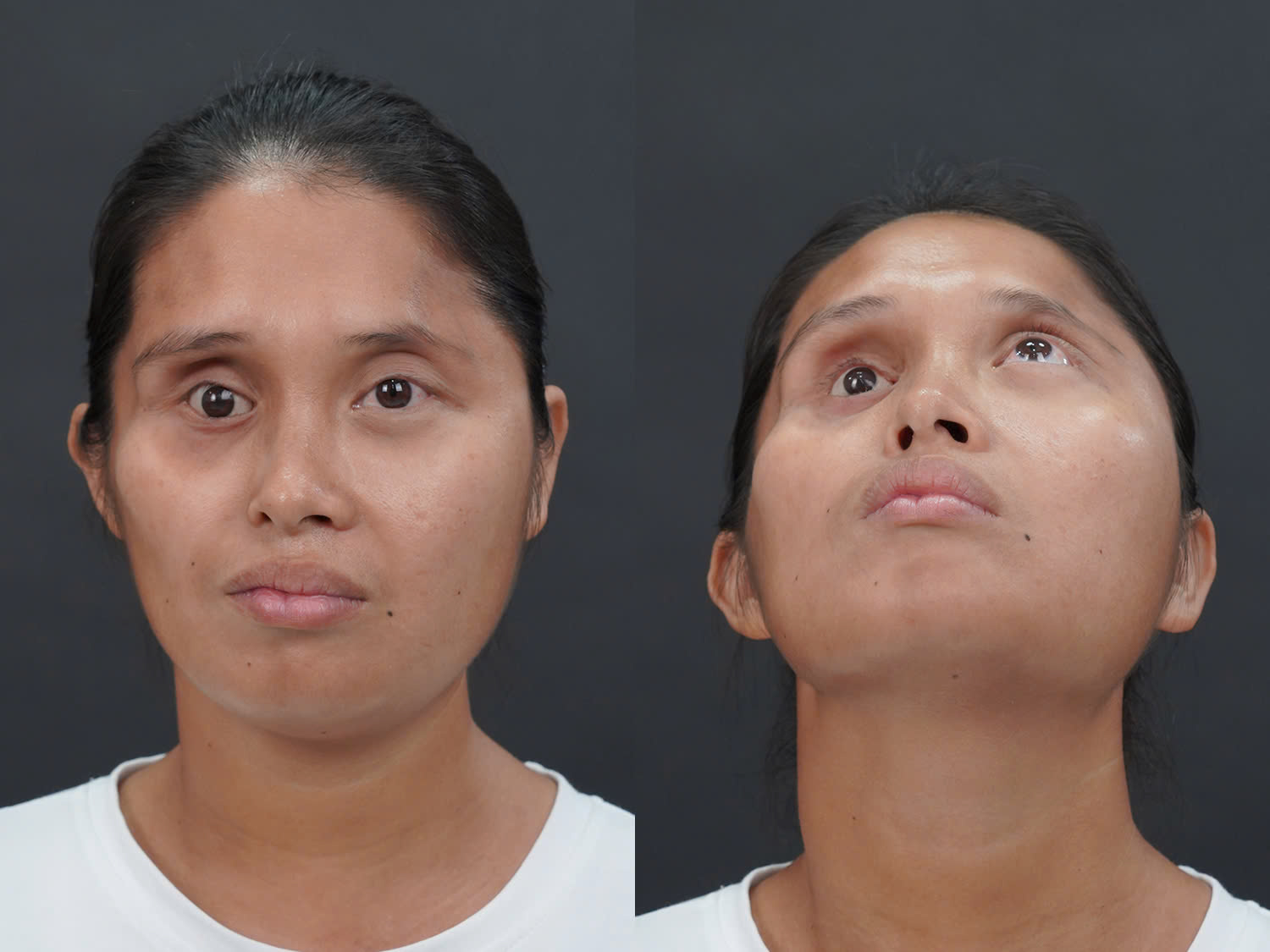 Yến bị suy giảm thị lực do đột biến NST gây ra