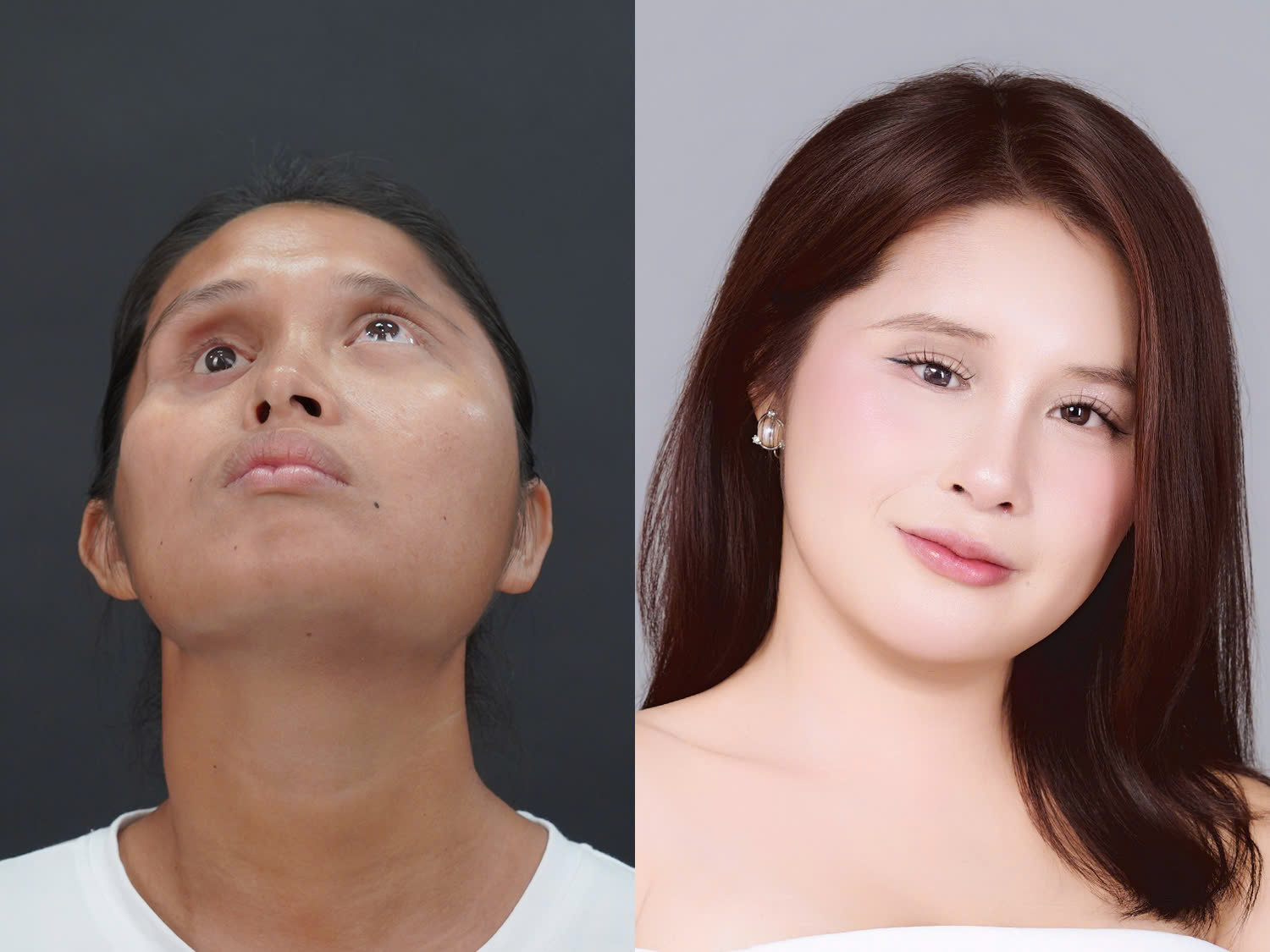 Lê Thị Yến trước và sau khi được phẫu thuật thẩm mỹ, gương mặt cân đối, đường nét hài hòa