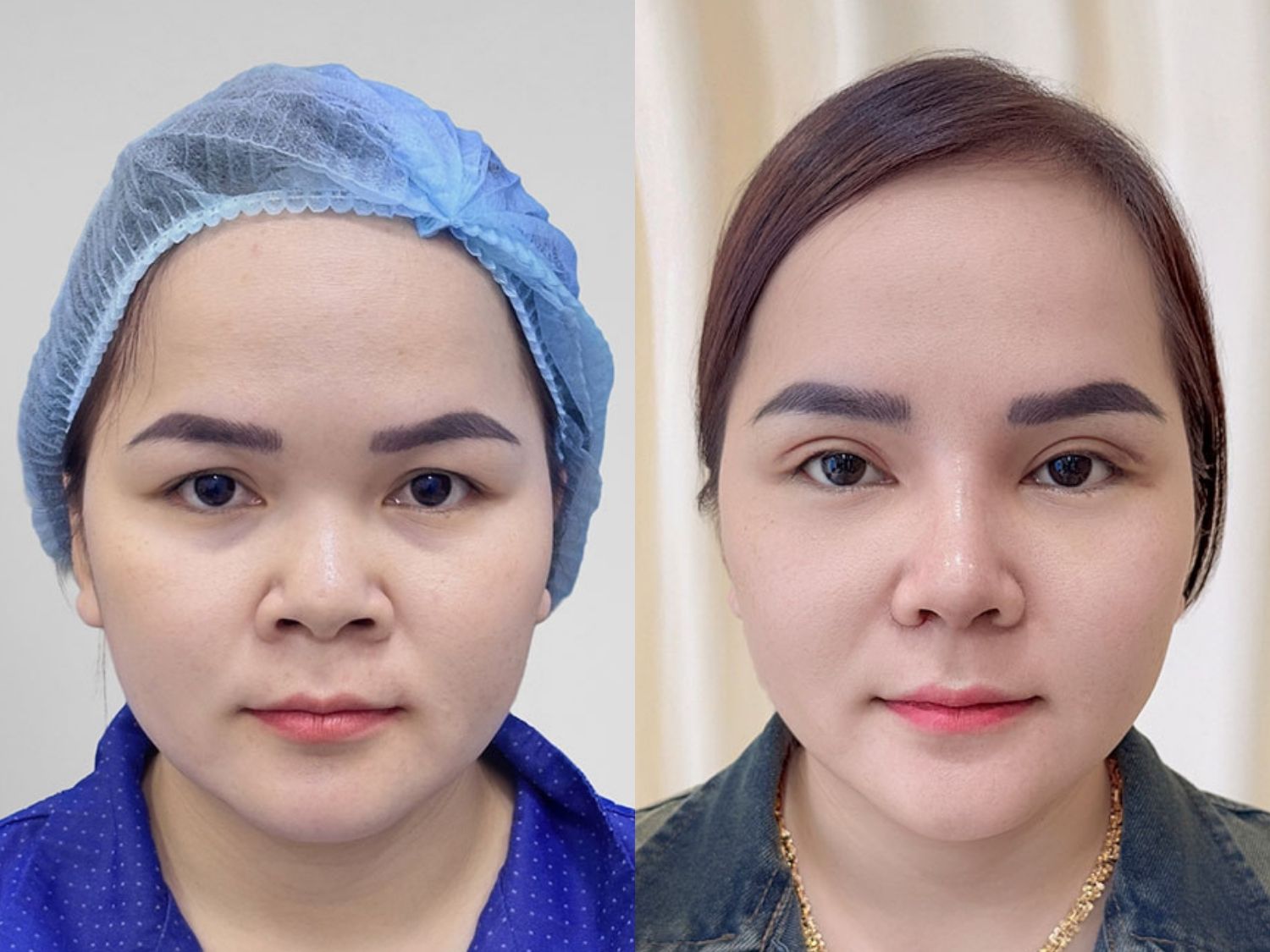 Hình ảnh Before cho thấy đôi mắt mí lót, hơi buồn và mệt mỏi. Kết quả After (bên phải) cho thấy nếp mí kép sắc nét, cân đối hoàn hảo, giúp tổng thể gương mặt Như Ý trở nên rạng rỡ