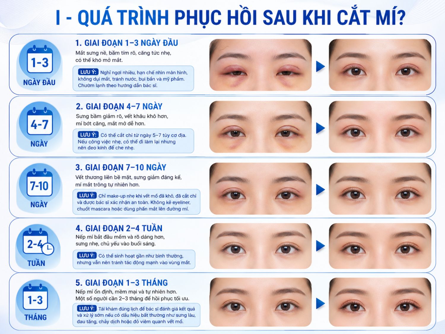 Quá trình hồi phục sau cắt mí thường diễn ra theo từng giai đoạn: sưng nhiều trong 1–3 ngày đầu, giảm dần sau 1 tuần và ổn định tự nhiên sau 1–3 tháng tùy cơ địa