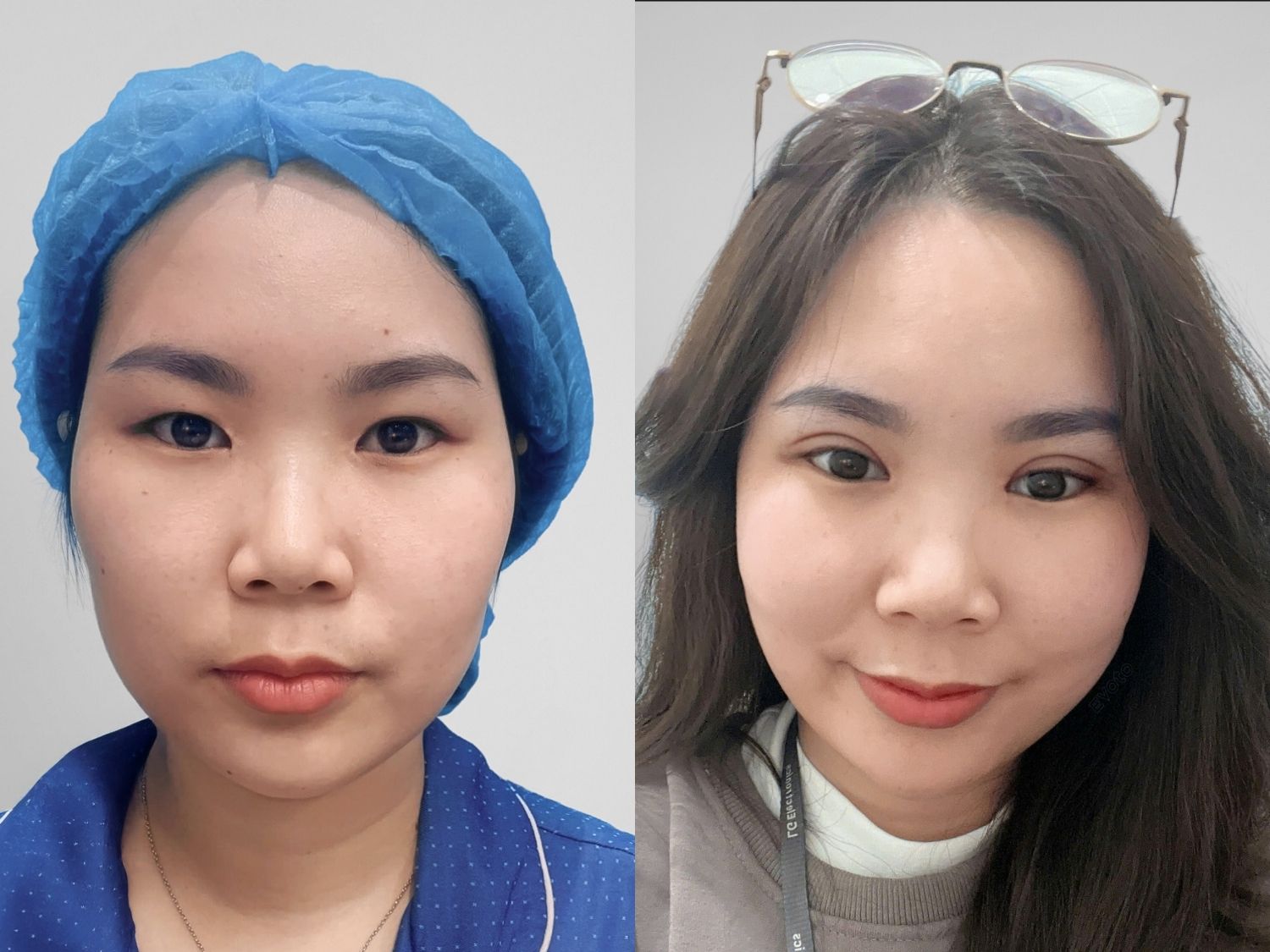 Bác sĩ thăm khám và đánh giá tình trạng của mỗi khách hàng, sau đó tư vấn phương pháp sửa lại