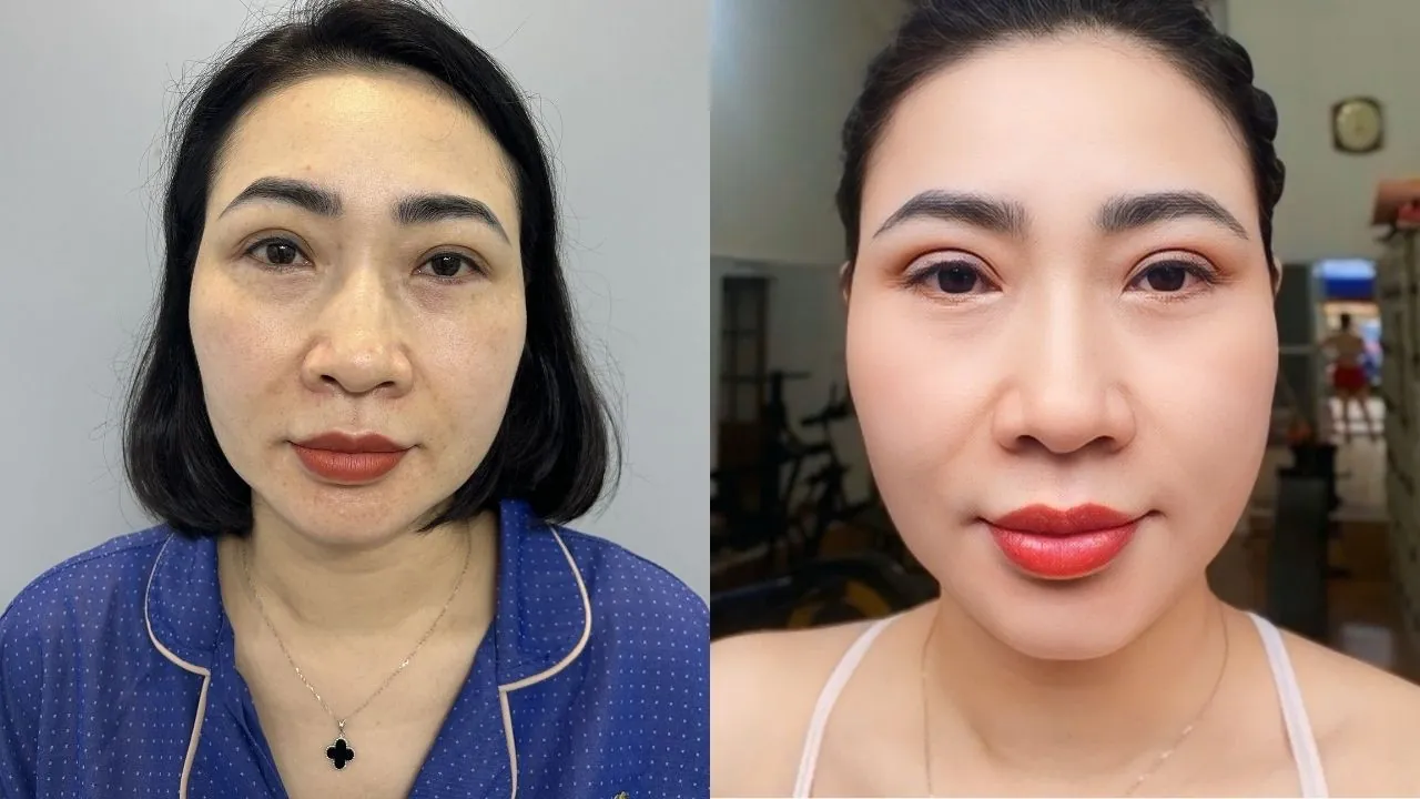 Chị Quỳnh Mai cắt chỉ mí mắt sau 7 ngày cắt mí, nếp mí đã to rõ ràng và dần tự nhiên hơn