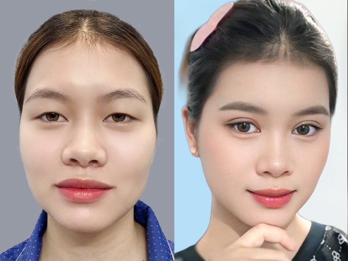 khách hàng trước và sau khi cắt mí tại Kangnam, mí cân đối, đẹp và không ảnh hưởng đến thị lực