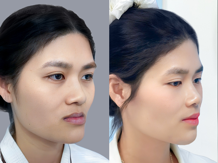 Kết quả chỉnh hàm giúp cải thiện tỷ lệ gương mặt, khớp cắn và đường nét tổng thể hài hòa tự nhiên hơn.
