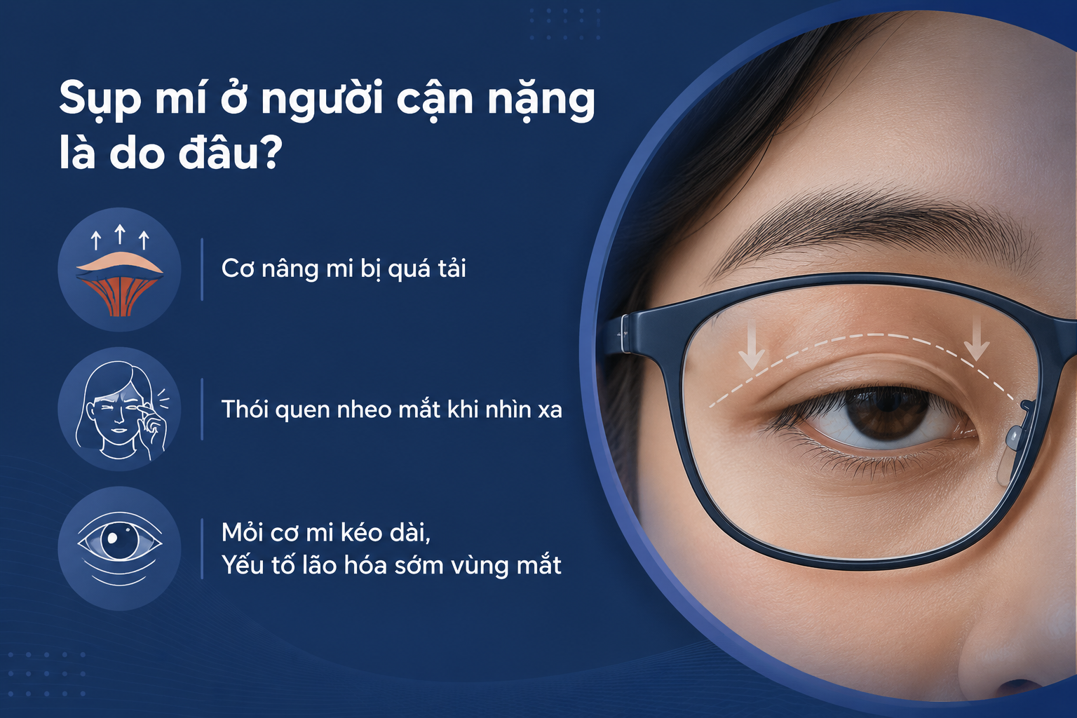 ảnh mô tả các nguyên nhân Sụp mí ở người cận nặng gồm cơ nâng mi quá tải, thói quen nheo mắt và mỏi cơ nâng mi kéo dài