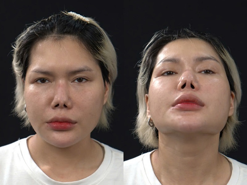 Trường hợp mũi cong vẹo, da mũi mỏng sau nhiều lần chỉnh sửa