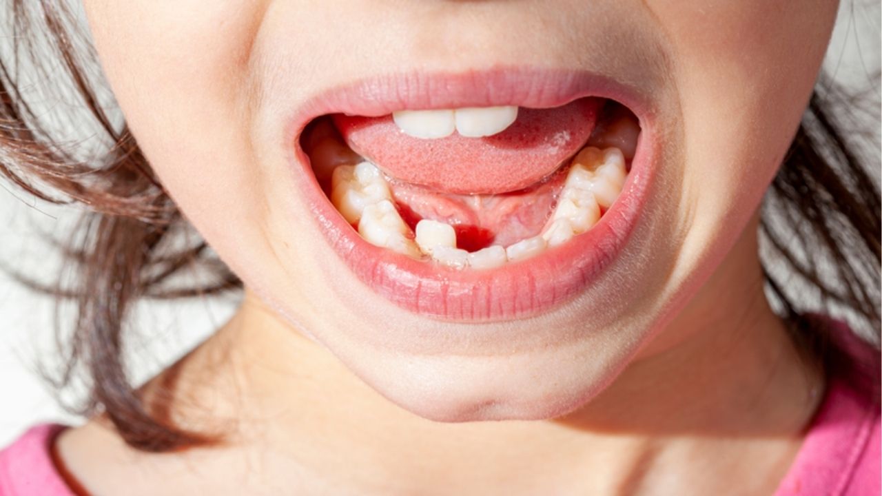 Khớp cắn lệch, hai hàm không khớp nhau là tình trạng chỉnh hàm hỏng
