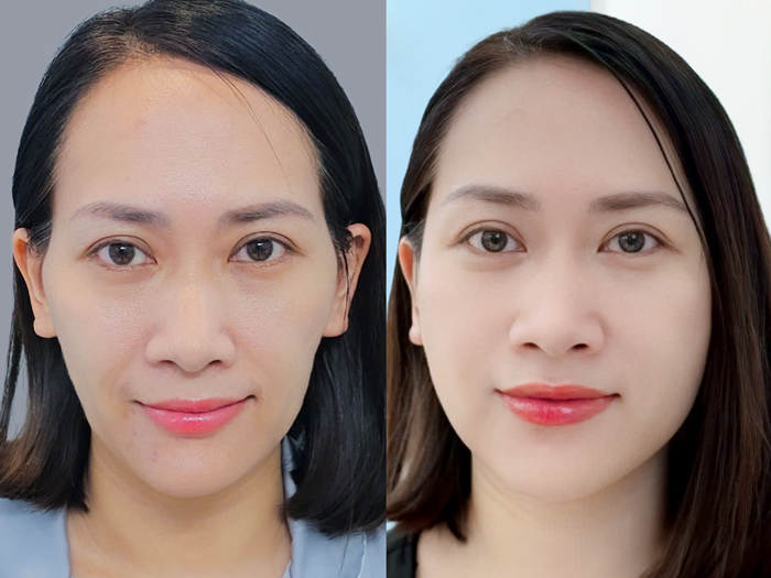 ảnh khách hàng trước và sau khi cấy mỡ mặt tại Kangnam, gương mặt đầy đặn và trẻ trung hơn