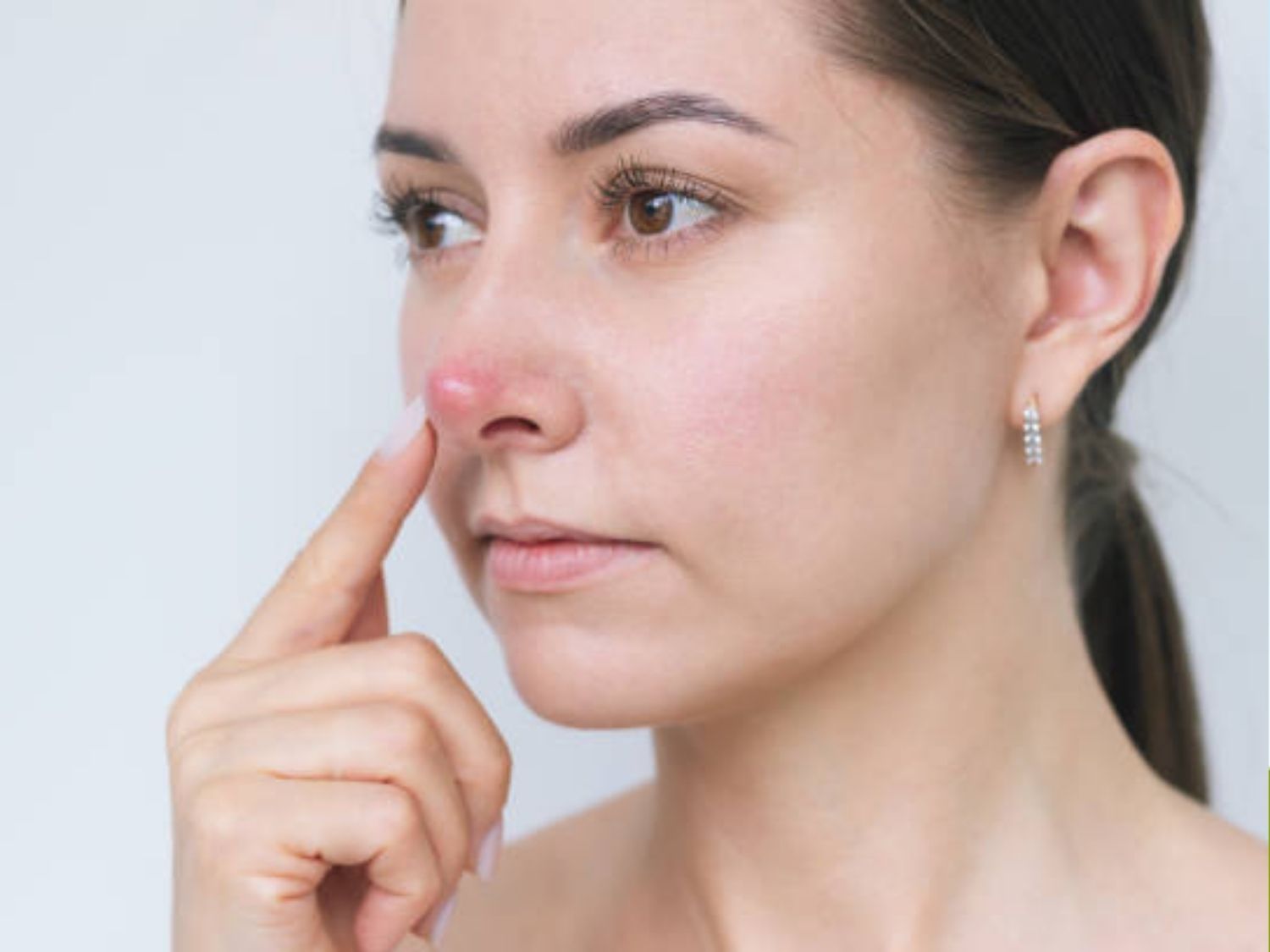 ảnh khách tình trạng Da mũi quá mỏng khiến lộ sụn, ghép trung bì tăng độ dày của da