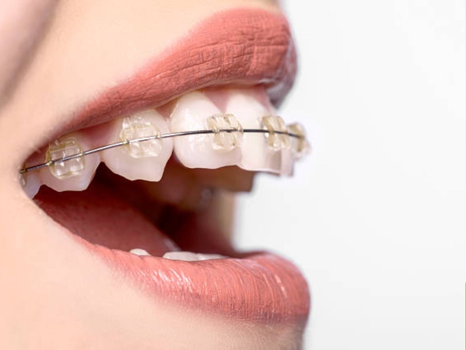Niềng răng trước, phẫu thuật sau để sắp xếp răng và chuẩn bị khớp cắn, sau đó mới tiến hành phẫu thuật chỉnh hàm