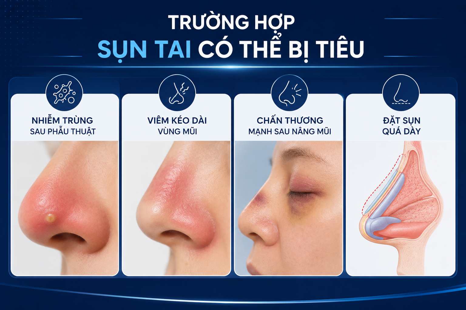 ảnh mô phỏng các trường hợp nâng mũi sụn tai bị tiêu sụn