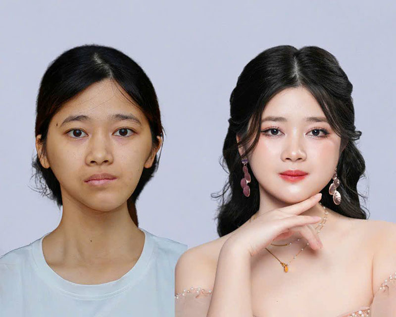 Ninh Thị Thu Hường trước và sau khi chỉnh hàm, gương mặt cân đối lấy lại sự tự tin