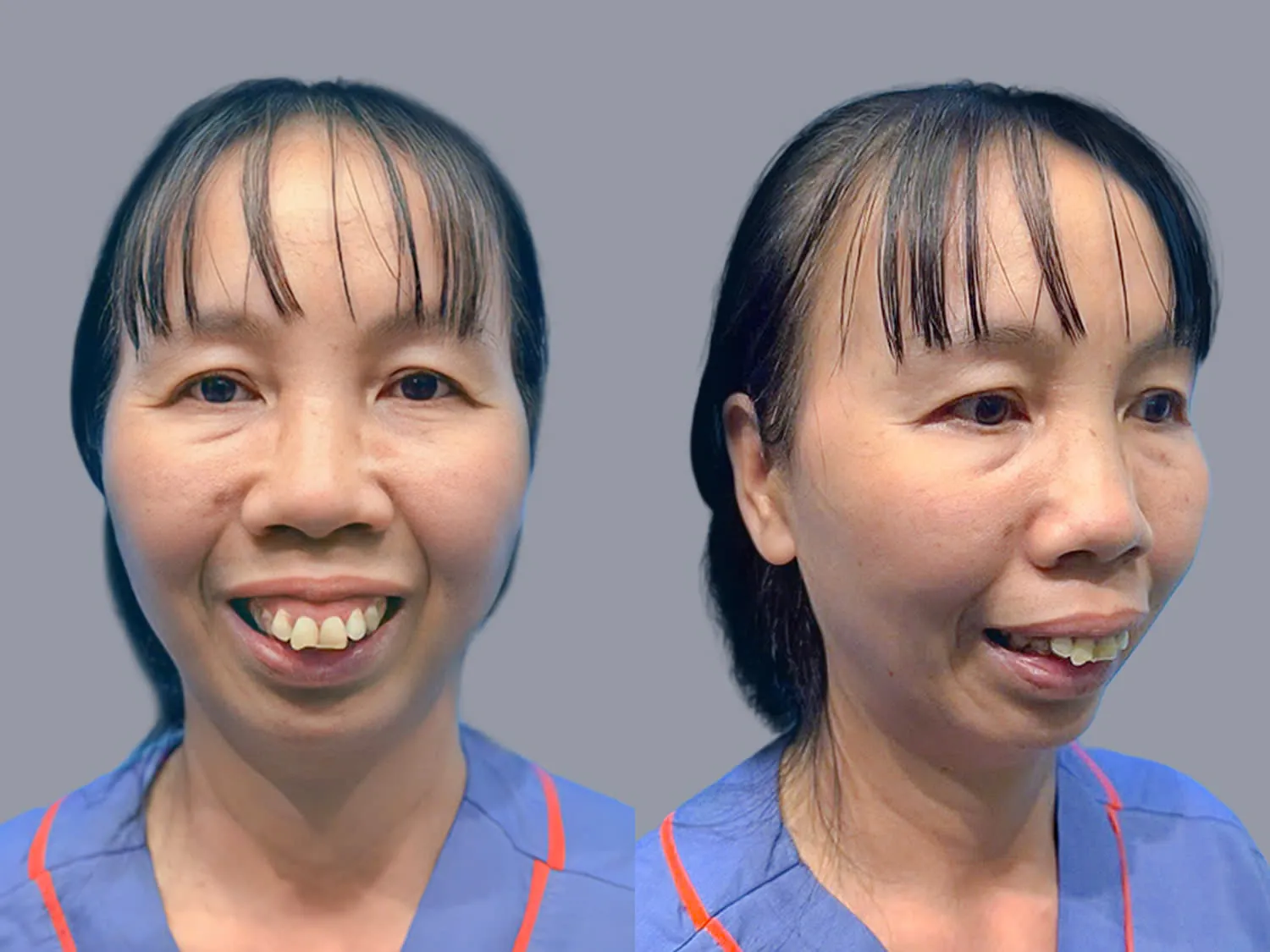 Cô Vũ Thị Thảo gặp tình trạng hàm hô nặng