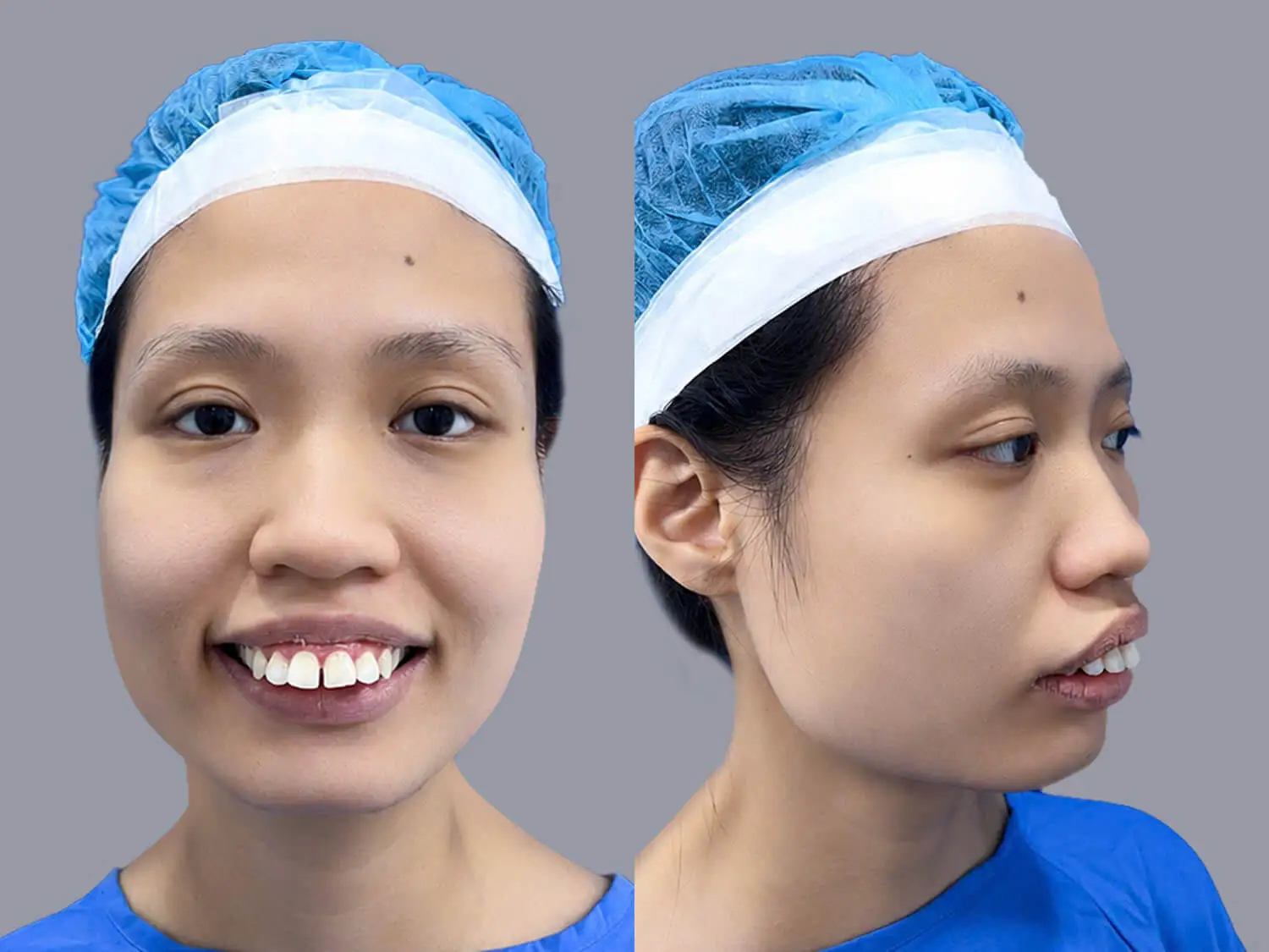 Khách hàng Vũ Thị Tình, 30 tuổi gặp tình trạng hàm hô nặng, răng chìa ra ngoài