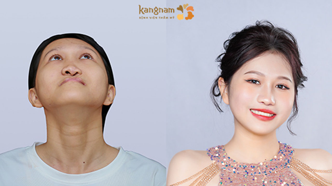 Trần Thị Xuân Mai trước và sau khi Điều trị dị tật khe hở môi vòm và sai lệch xương hàm phức tạp