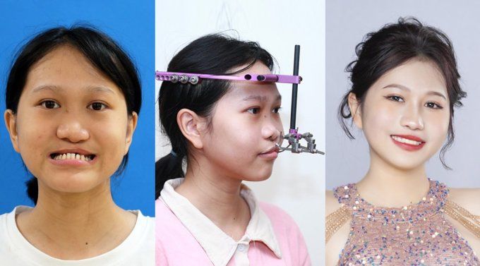 Xuân Mai gặp tình trạng sứt môi, hở hàm ếch đã tái sinh nhan sắc thành công tại Kangnam