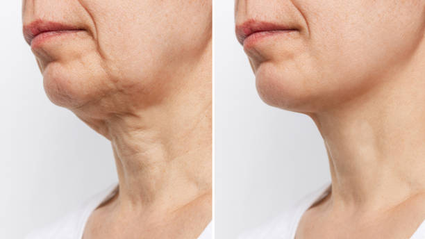 ảnh trước và sau khi áp dụng phẫu thuật căng da mặt đối với tình trạng lão hóa da tuổi tác