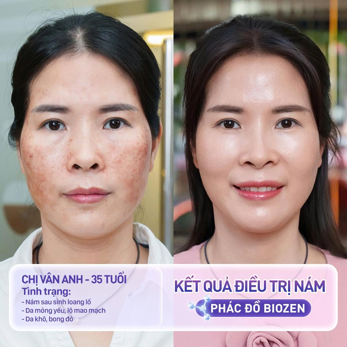 ảnh trước và sau so sánh của Khách hàng trị nám thành công bằng Laser Pico