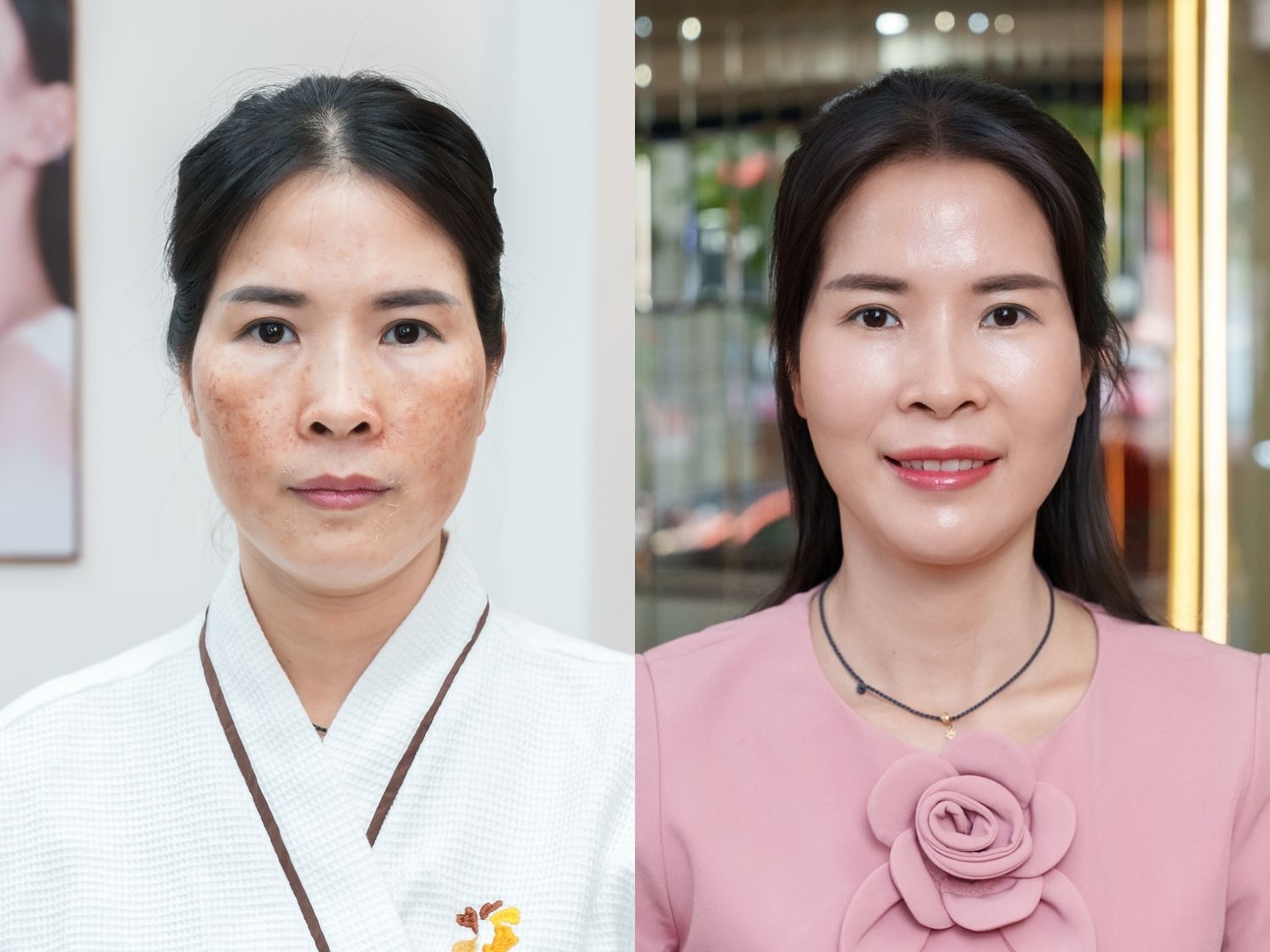 Khách hàng trị nám hiệu quả bằng laser tại Kangnam
