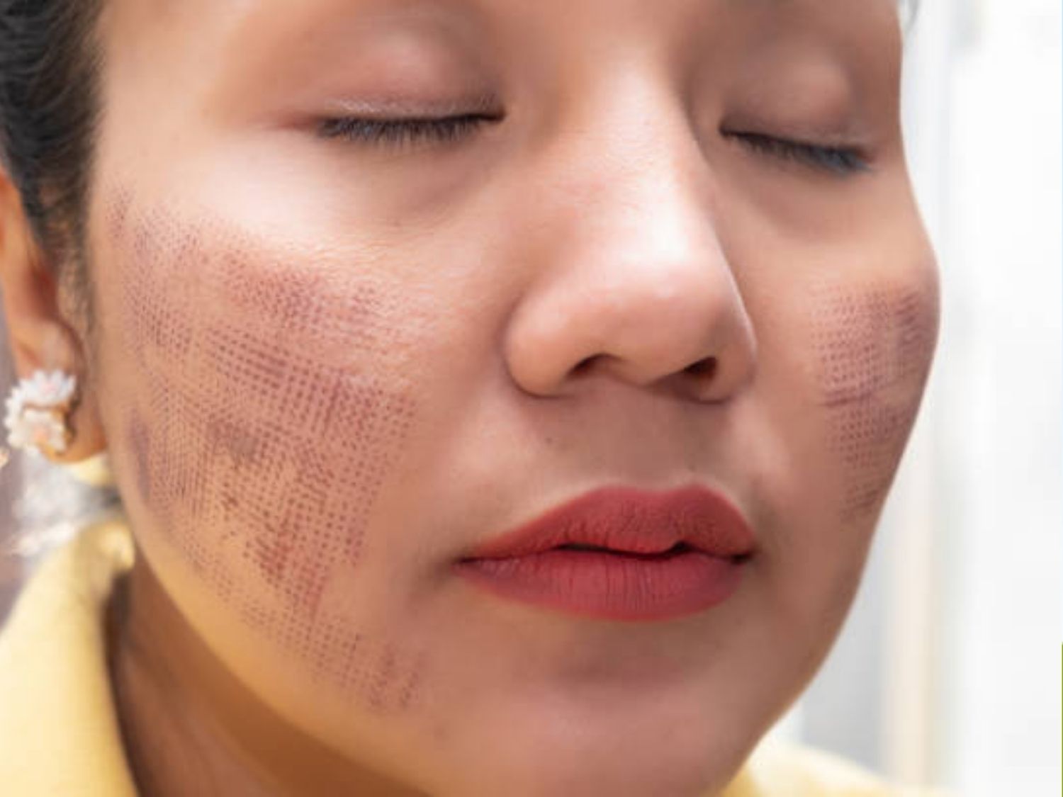 cô gái bị Bỏng da, đỏ rát kéo dài do thực hiện hifu tại cơ sở kém uy tín