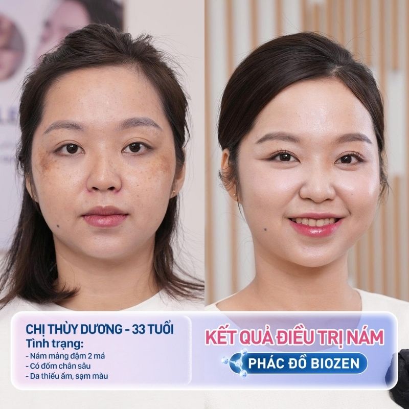 ảnh so sánh trước sau Thùy Dương trị nám da thành công nhờ Laser Pico