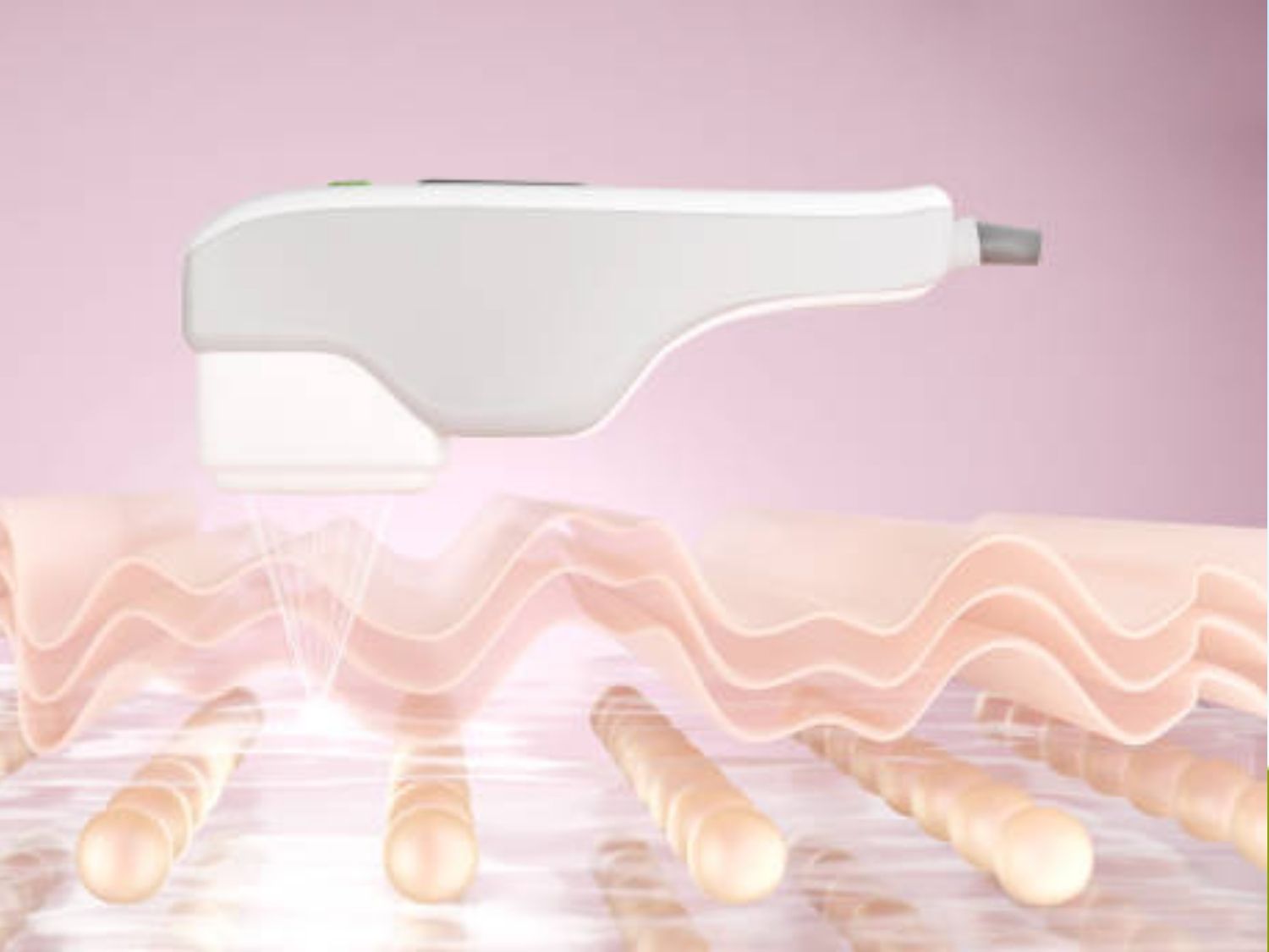 ảnh mô phỏng Cơ chế hoạt động của HIFU LinearZ trên làn da