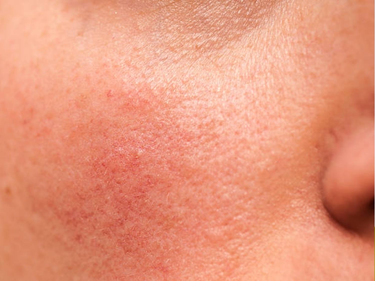 HIFU LinersZ có thể gây đỏ da nhẹ và tự hết