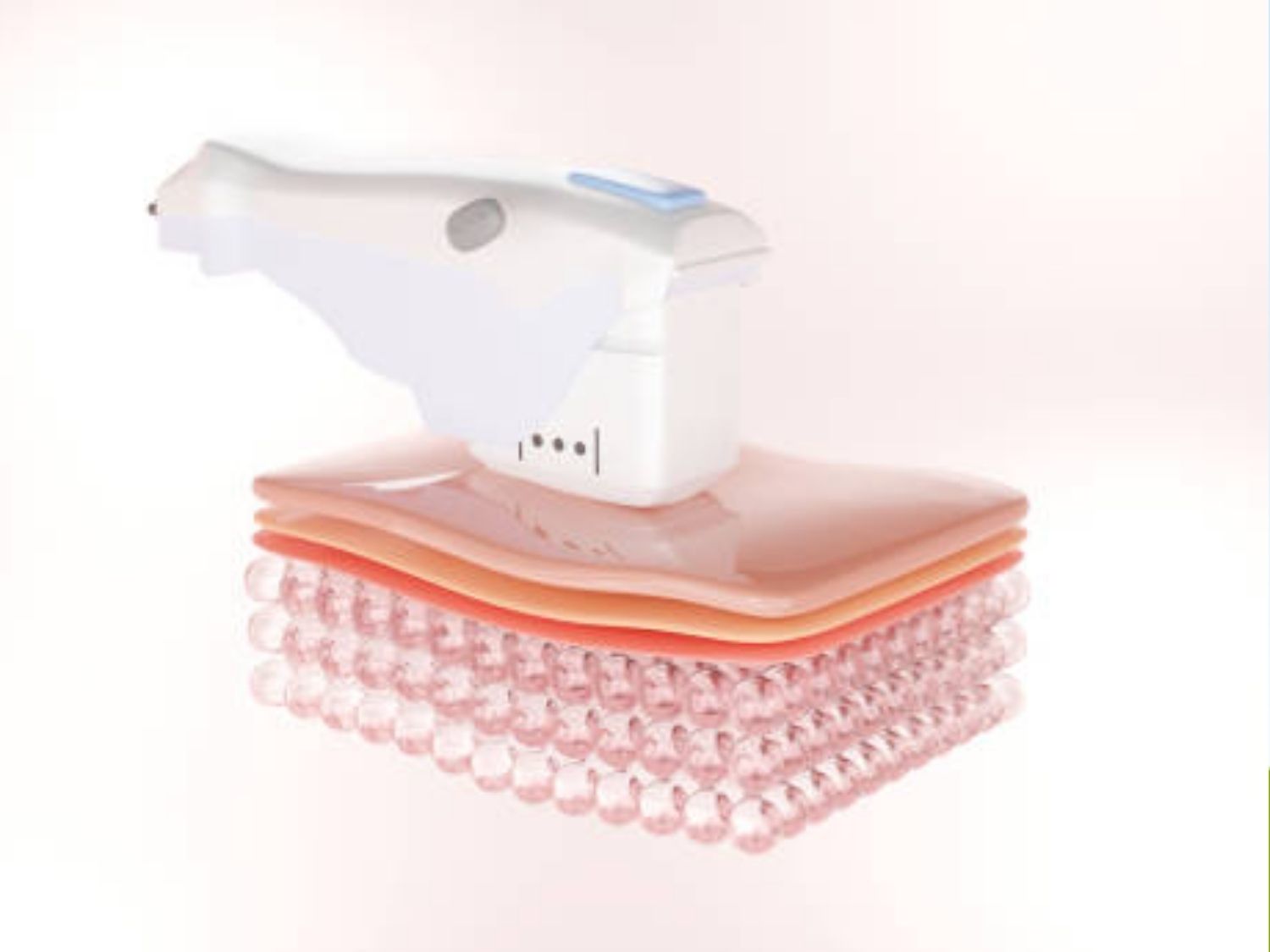 ảnh mô phỏng Máy Hifu trên lớp biểu bì da