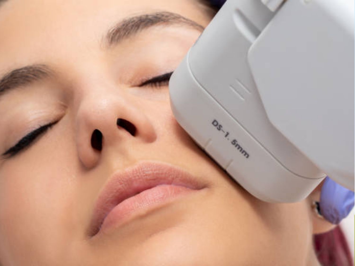 máy HIFU (High-Intensity Focused Ultrasound) cường độ cao đang tác động vào lớp cơ nông SMAS