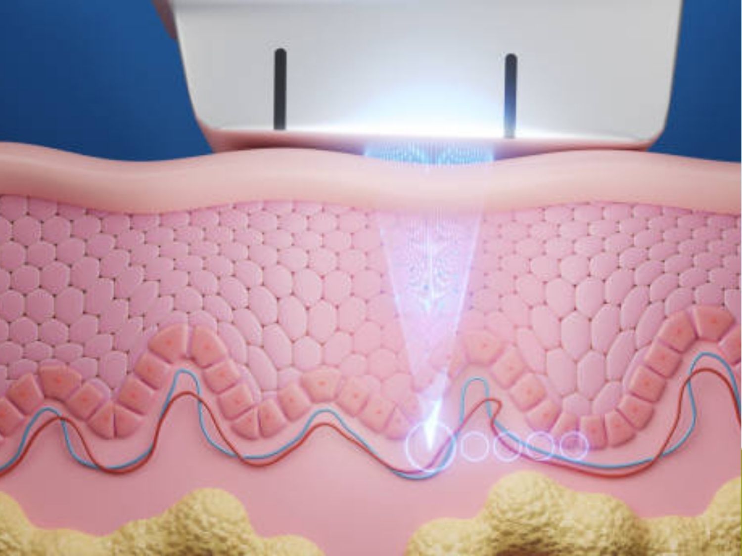 Nguyên lý vận hành của Laser Pico Discovery trên làn da