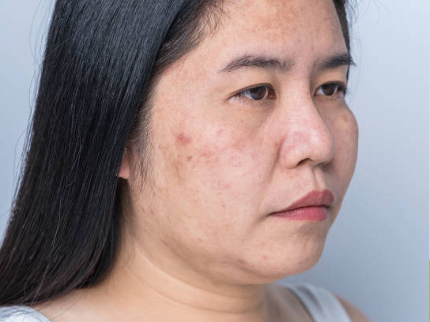 tình trạng da bị Tăng sắc tố sau viêm